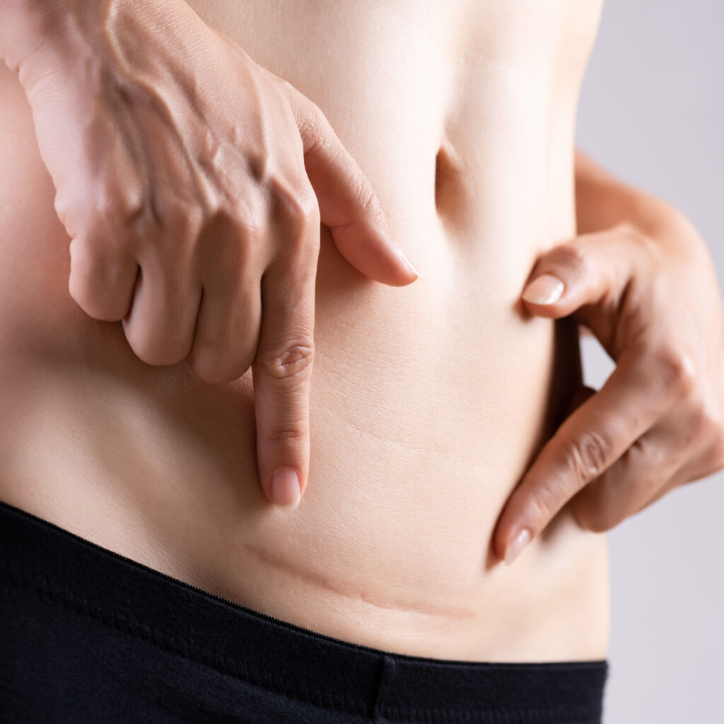 Closeup of woman showing on her belly dark scar from a cesarean